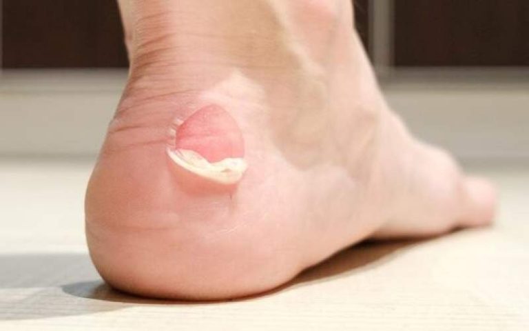 چگونه از تاول زدن پیشگیری کنیم؟