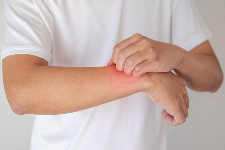 چگونه بیماری اِگزِما را مدیریت کنیم؟