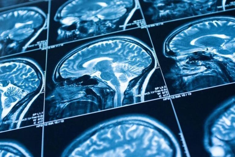 مغز افراد روان‌آزار