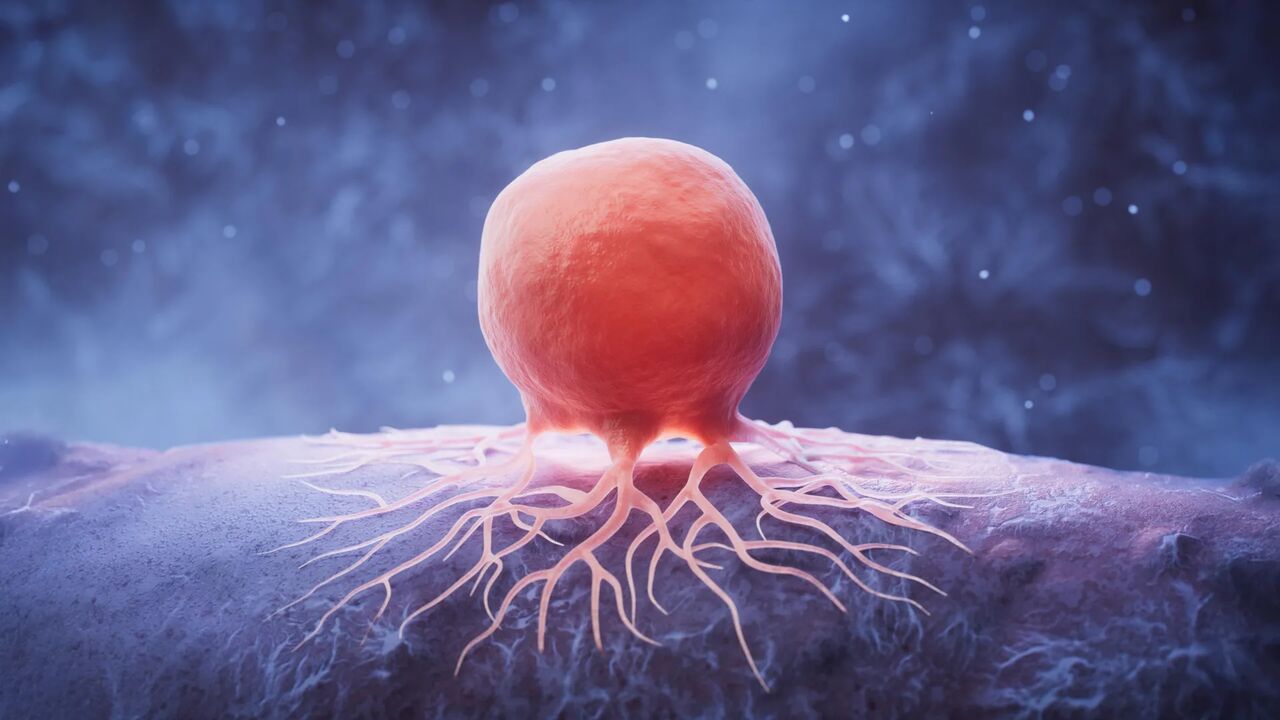 سرطان پستان