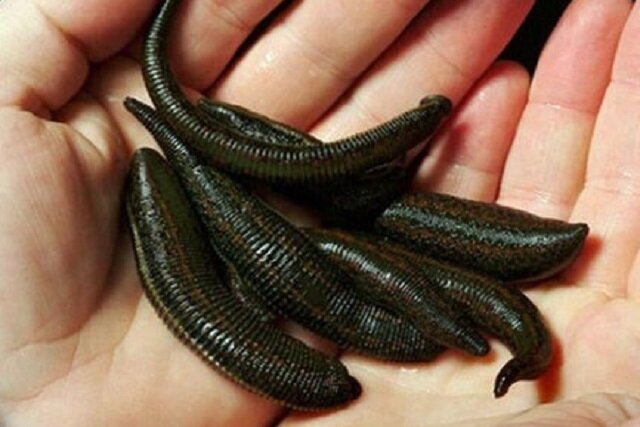 «زالو درمانی»