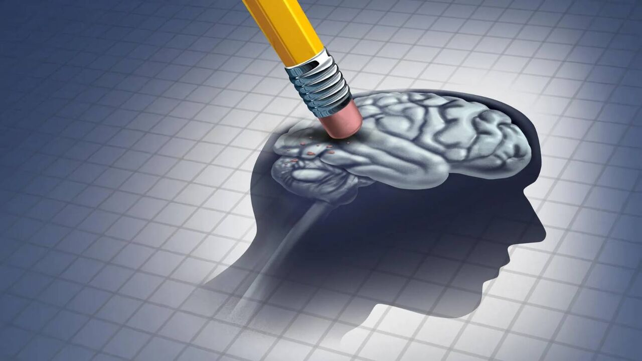 آلزایمر