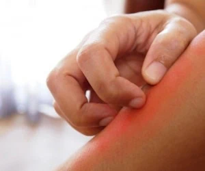 دور کردن پشه