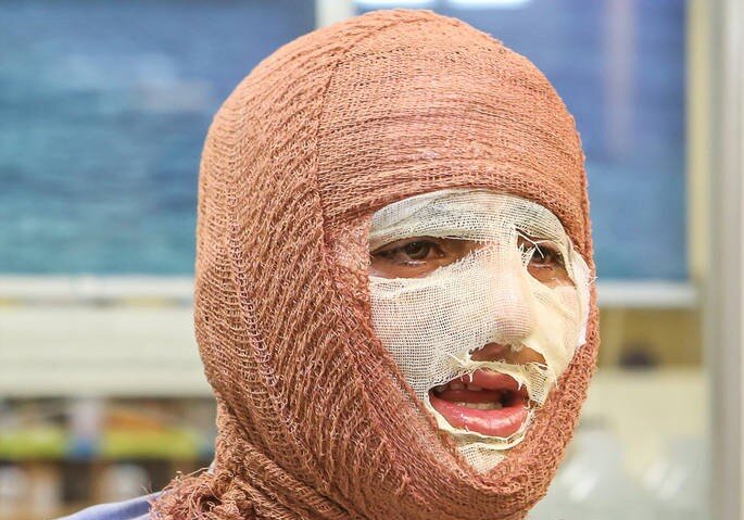 سوختگی