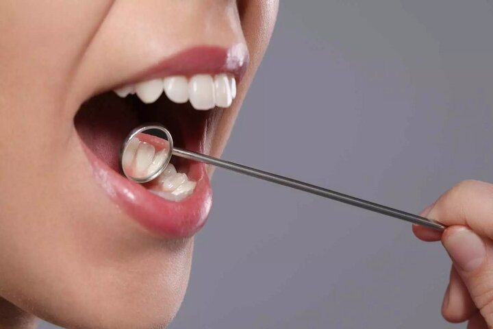 امپوزیت‌های دندانی